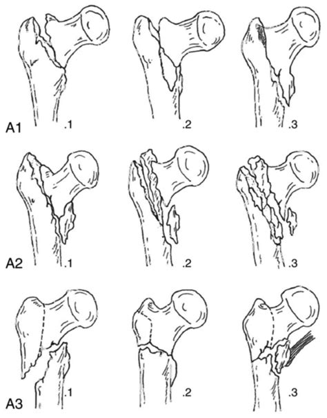 Long Nail Insertion Telegraph