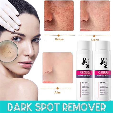 Effective Freckle Removal Whitening Cream Melasma Removal Cream Anti