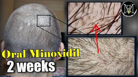 Oral Minoxidil Loniten Weeks Update Youtube