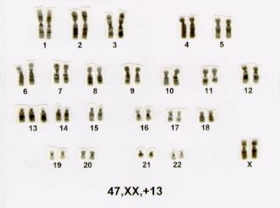 Biologia S Ndrome De Patau Ou Trissomia Do