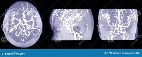 Mri Of The Brain And Mra Mrv Of The Brain Stock Image Image Of