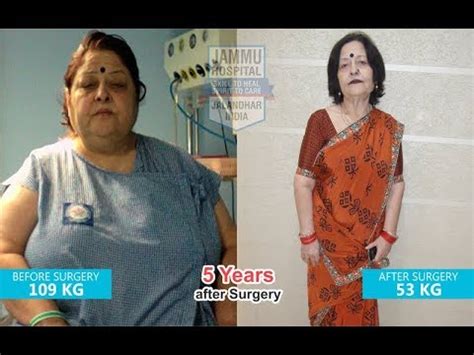 Kg To Kg In Years After Mini Gastric Bypass Surgery In India