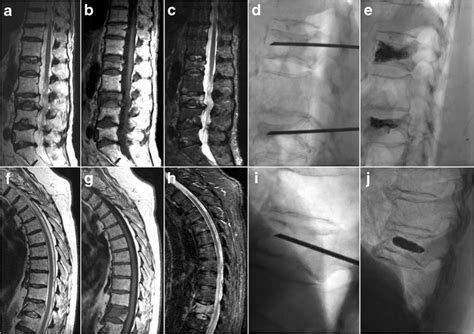 Osteoporotic And Pathologic Vertebral Compression Fractures Before And