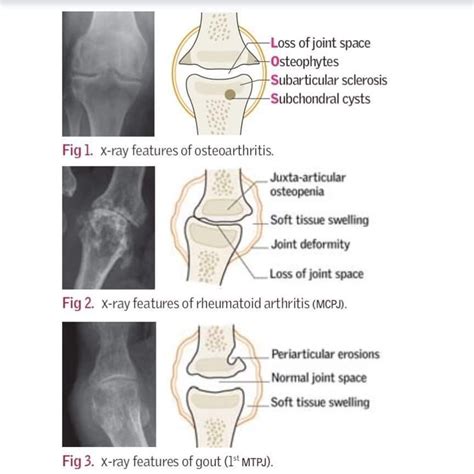 Bone bruise types symptoms treatment healing time ehealthstar – Artofit