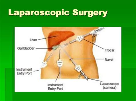 Ppt Laparoscopic Surgery Powerpoint Presentation Free Download Id 1390227