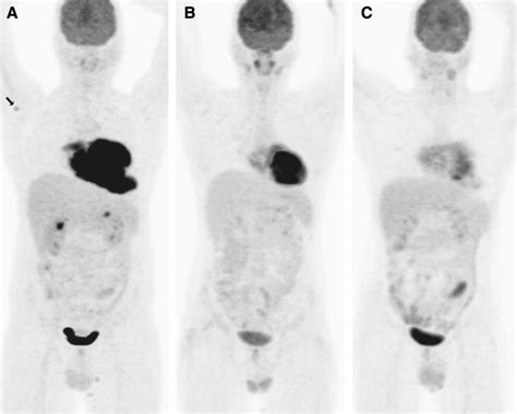 Fdg Petct In The Staging And Follow Up Of Primary Cardiac ‘t Cell