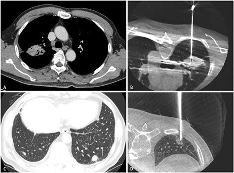 Tissue Adequacy And Safety Of Percutaneous Transthoracic Needle Biopsy