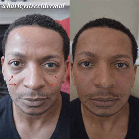 Cheek Fillers for Men of All Ages | Harley Street Dermal
