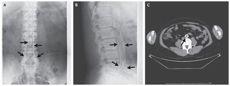 Calcification Of The Aorta And Common Iliac Arteries Nejm