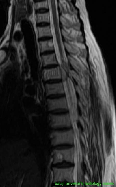 Dr Balaji Anvekar Frcr Aggressive Hemangioma Mri Spine