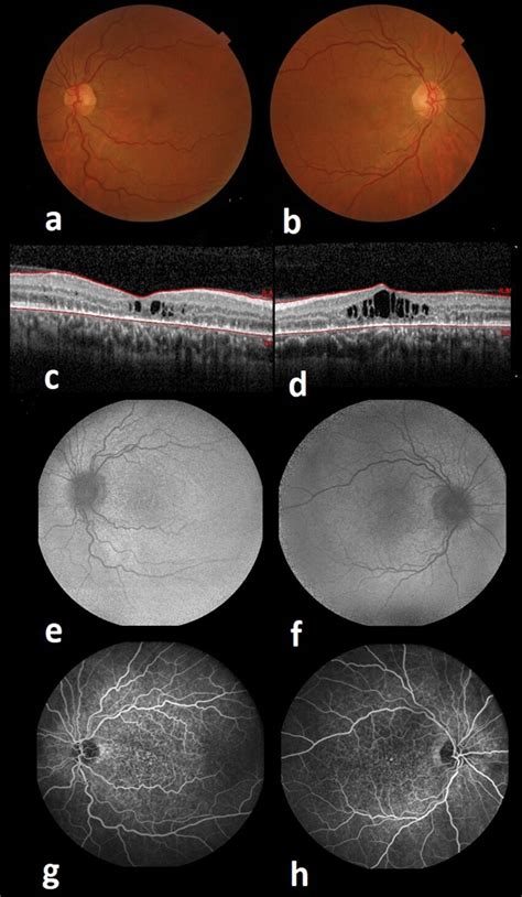 A And B Fundus Examination Revealed Venous Tortuosity As Well As