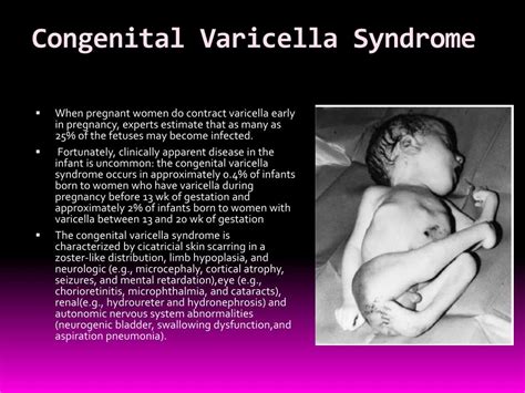 Ppt Varicella Zoster Virus Powerpoint Presentation Free Download Id 4168209