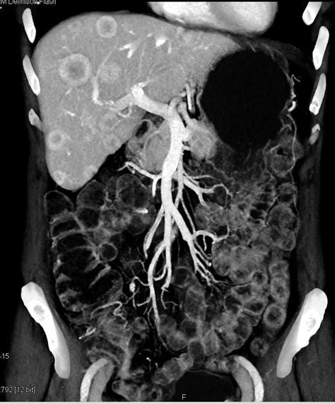 Metastatic Carcinoid Tumor To The Liver Liver Case Studies Ctisus