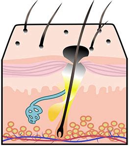 What Causes Blackheads? | Paula's Choice