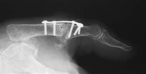 Reconstruction Thumb Metacarpophalangeal Joint Arthrodesis With Plates