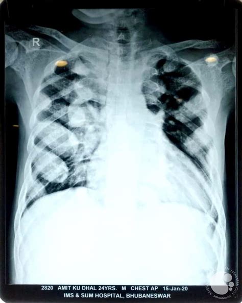 extramedullary hematopoiesis morphologic  immunohistochemical