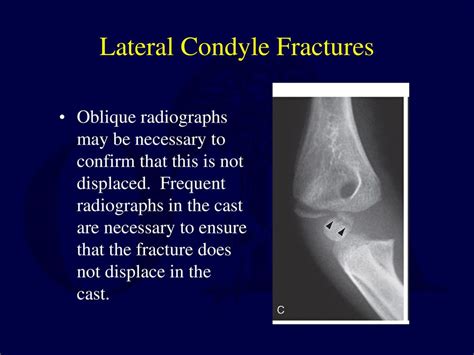 Fractures And Dislocations About The Elbow In The Pediatric Patient