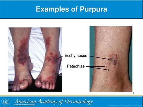 PPT - Petechiae, Purpura and Vasculitis PowerPoint Presentation, free download - ID:3662842