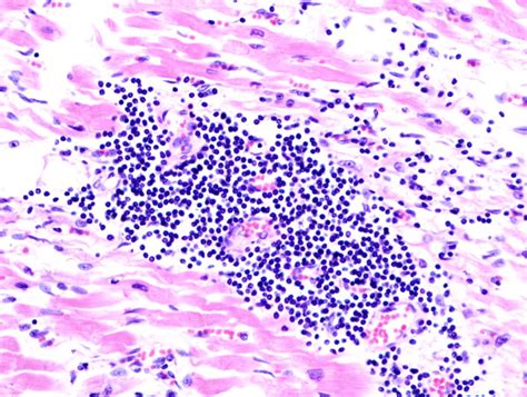 Miocarditis Wikipedia La Enciclopedia Libre