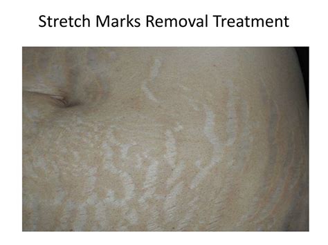 PPT - Stretch Marks Removal Treatment PowerPoint Presentation, free ...