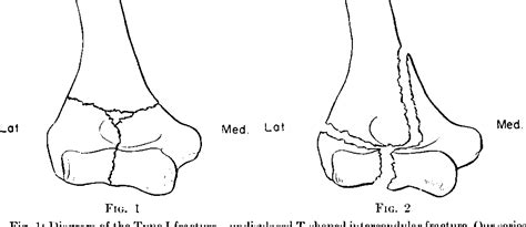 Figure 1 From Intercondylar T Fractures Of The Humerus In The Adult A Comparison Of Operative