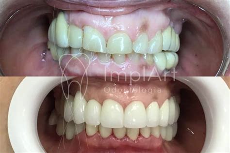 Coroa Porcelana Metal Free Antes E Depois 50kb ImplArt