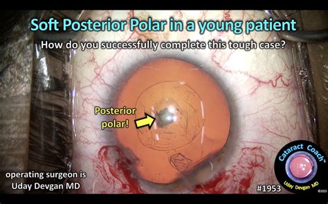 soft posterior polar cataract young patient