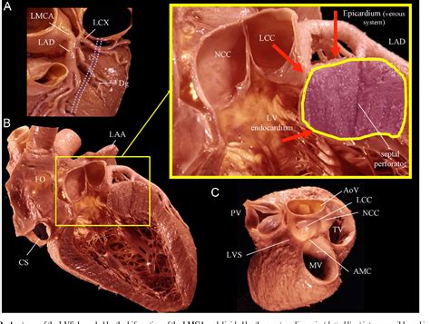 Figure From How To Map And Ablate Left Ventricular Summit Arrhythmias