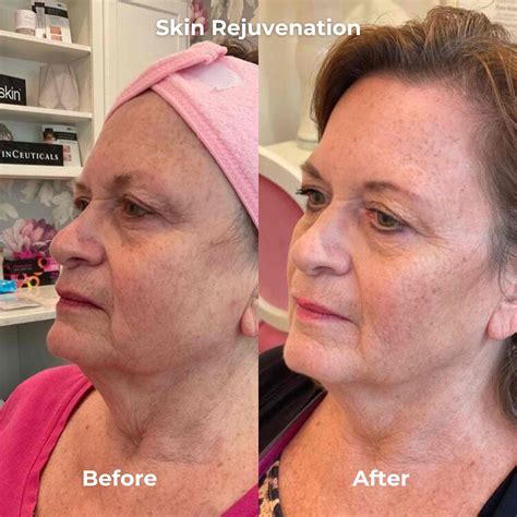 RF Microneedling Before After Results