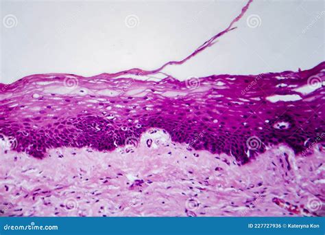 Cervical Ectropion, Light Micrograph Stock Photo | CartoonDealer.com #227727936