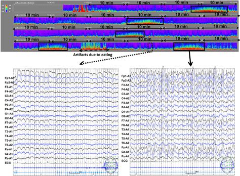 Color Density Spectral Array Cdsa For The Eeg Data Of Case On The