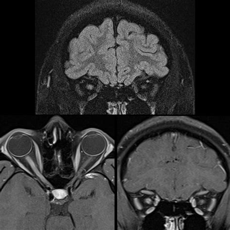 Pediatric Optic Neuritis | Pediatric Radiology Reference Article ...