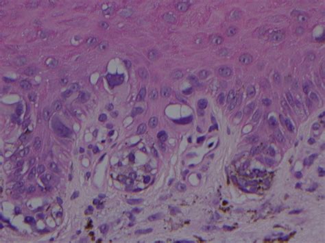 Acral Lentiginous Melanoma Histology