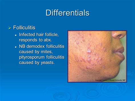 25 Best Demodex Folliculitis Treatment - Demodectic Mange