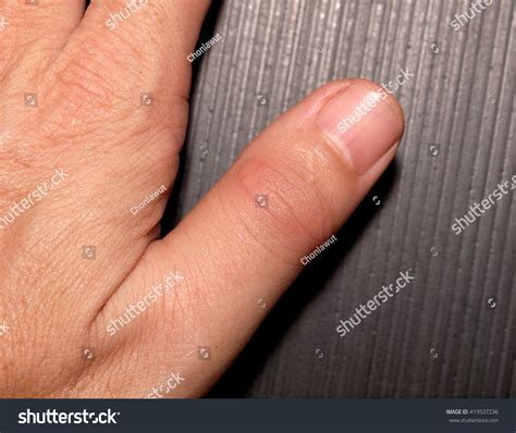 Left Thumb Finger Joint Get Sudden Intense Pain In A Night Without