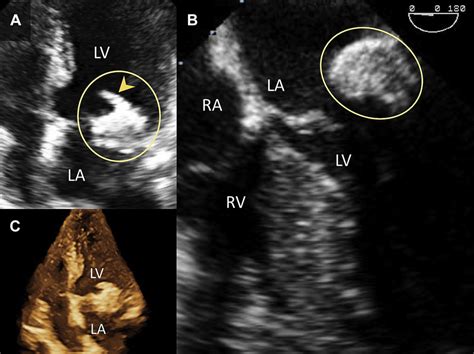 Caseous Calcification Of The Mitral Annulus A B Circles With An