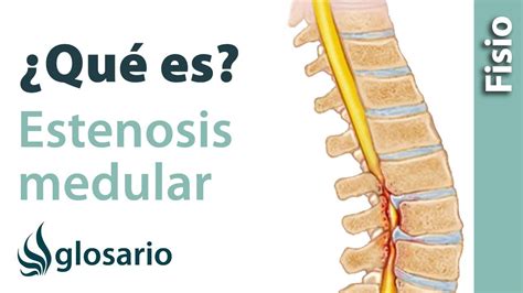 Estenosis Del Canal Lumbar Qu Es Youtube