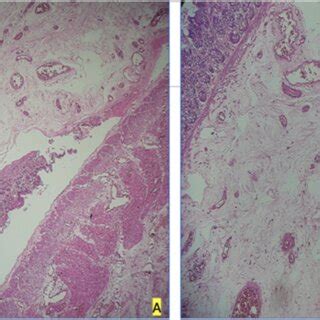 A Magnification Shows Mucosal Denudation With Decreased Crypts In