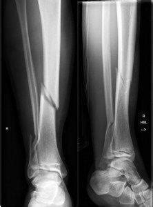 Fractures Lower Leg