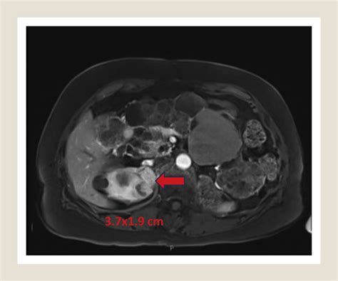 Preoperative Mri Showing Upper Pole Renal Mass Red Arrow Appearance