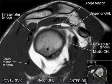 MRI Musculo-Skeletal Section: MRI anatomy of the shoulder (sagittal view).