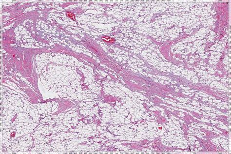 Pathology Outlines Lipoma