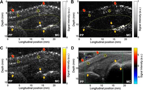 Pa And Us Dual Imaging Of A Right Hand 2 Nd Mcp Joint Of A Healthy Download Scientific Diagram