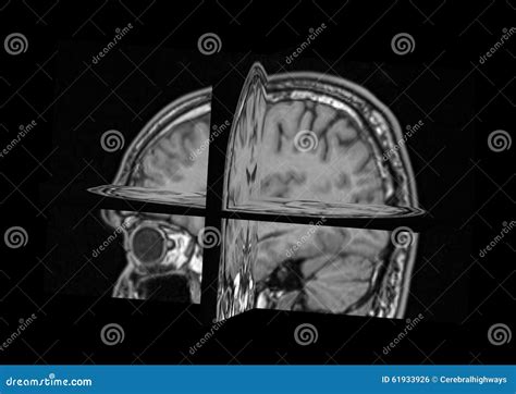 Mri脑子3d视图 库存照片 图片 包括有 表面 神经科学 共鸣 灰色 空白 问题 视图 磁性 61933926