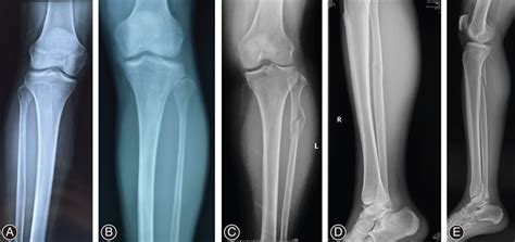 Manifestations of proximal fibular fractures. (A) Fibular neck ...