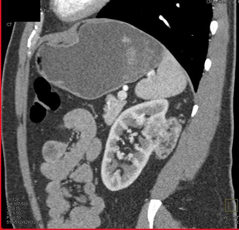 Renal Angiomyolipoma - Kidney Case Studies - CTisus CT Scanning