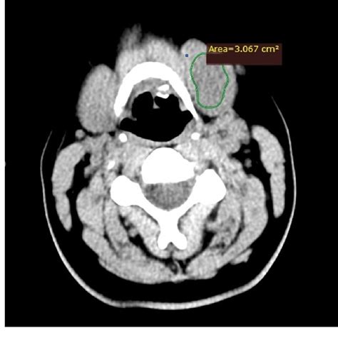 Figure 1 From Unmasking Hypoglossal Nerve Schwannomas Mimicking