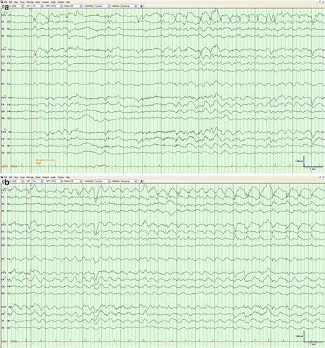 Which Eeg Patterns Deserve Treatment In The Icu Neupsy Key