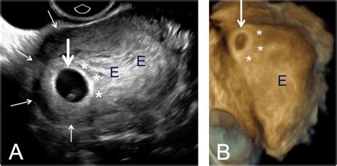 The Term “cornual Pregnancy” Should Be Abandoned Baltarowich 2017 Journal Of Ultrasound In