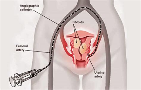 Fibroid Dan Bahayanya Pada Wanita Punca Simpton Dan Rawatan